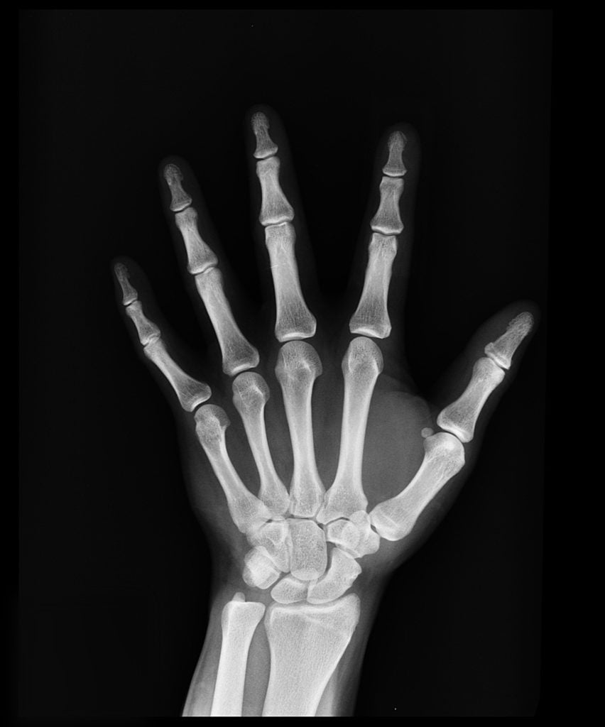 x-ray of hand