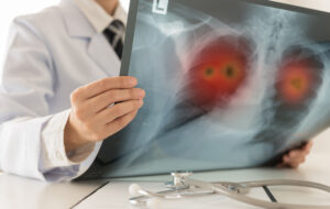 Doctor holding X-ray image of lungs