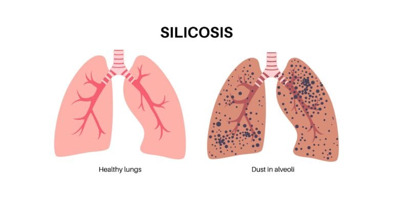 illustration of healthy lungs beside silica dust affected lungs