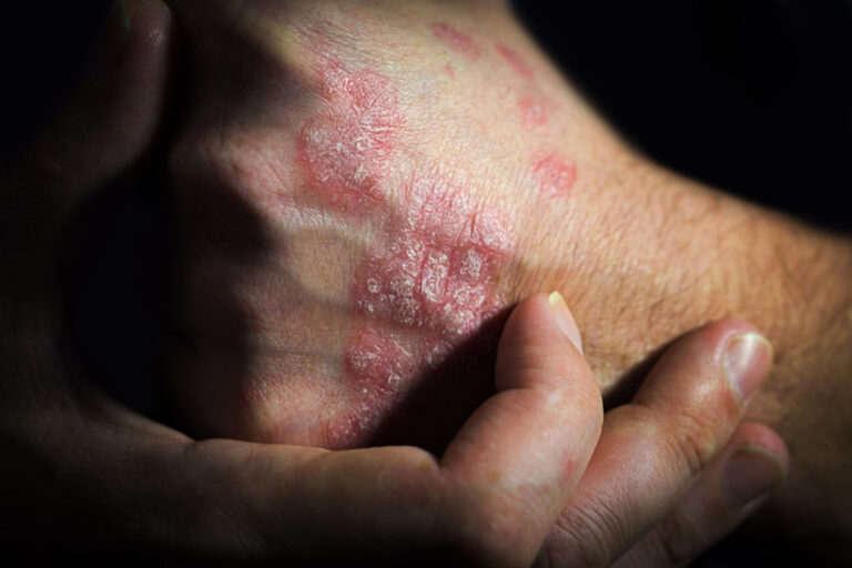 Dermatitis on hands